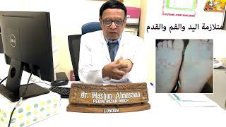 متلازمة اليد والقدم والفم (HAND FOOT MOUTH DISEASE-HFMD)