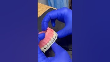 3D printed denture base and teeth try in