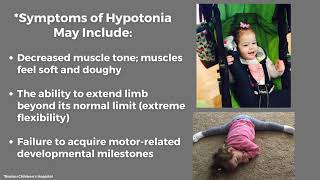 BBSOAS and Hypotonia