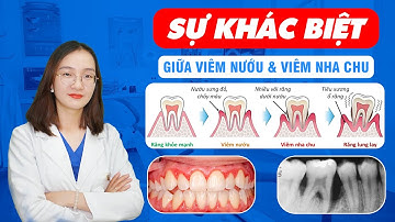 Sự Khác Biệt Giữa Viêm Nướu & Viêm Nha Chu | Nam Bùi Vinalign
