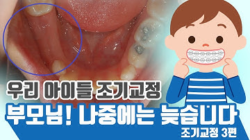 영구치가 다 나오기전에 치아교정 시작하는 아이들(3)!