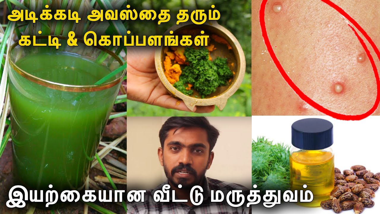 இதை ஒரு முறை செஞ்சி பாருங்க சூட்டு கட்டி காணாமல் போகும் ! Home Remedies
