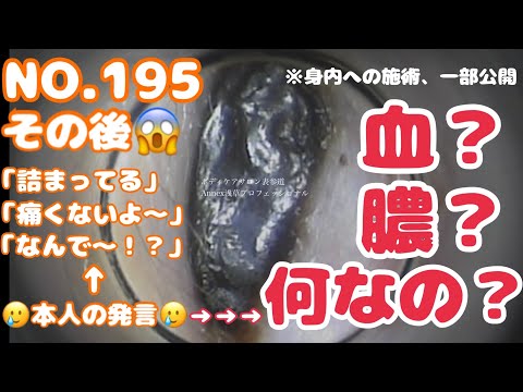 200 [195身内への施術] その後…#耳掃除 #耳かき   #japaneseearcleaning   #浅草 #asakusa #japan 