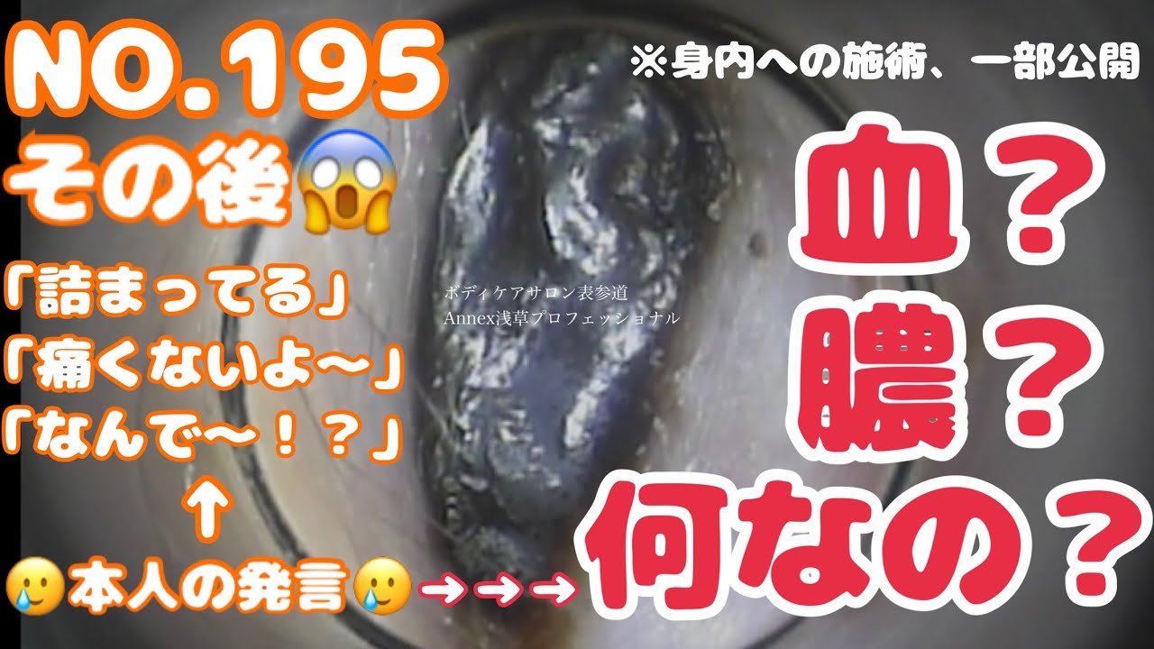 200 [195身内への施術] その後…#耳掃除 #耳かき #japaneseearcleaning