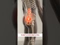 Cách Điều Trị Thoát Vị Đĩa Đệm Tốt Nhất Hiện Nay Là Gì?
