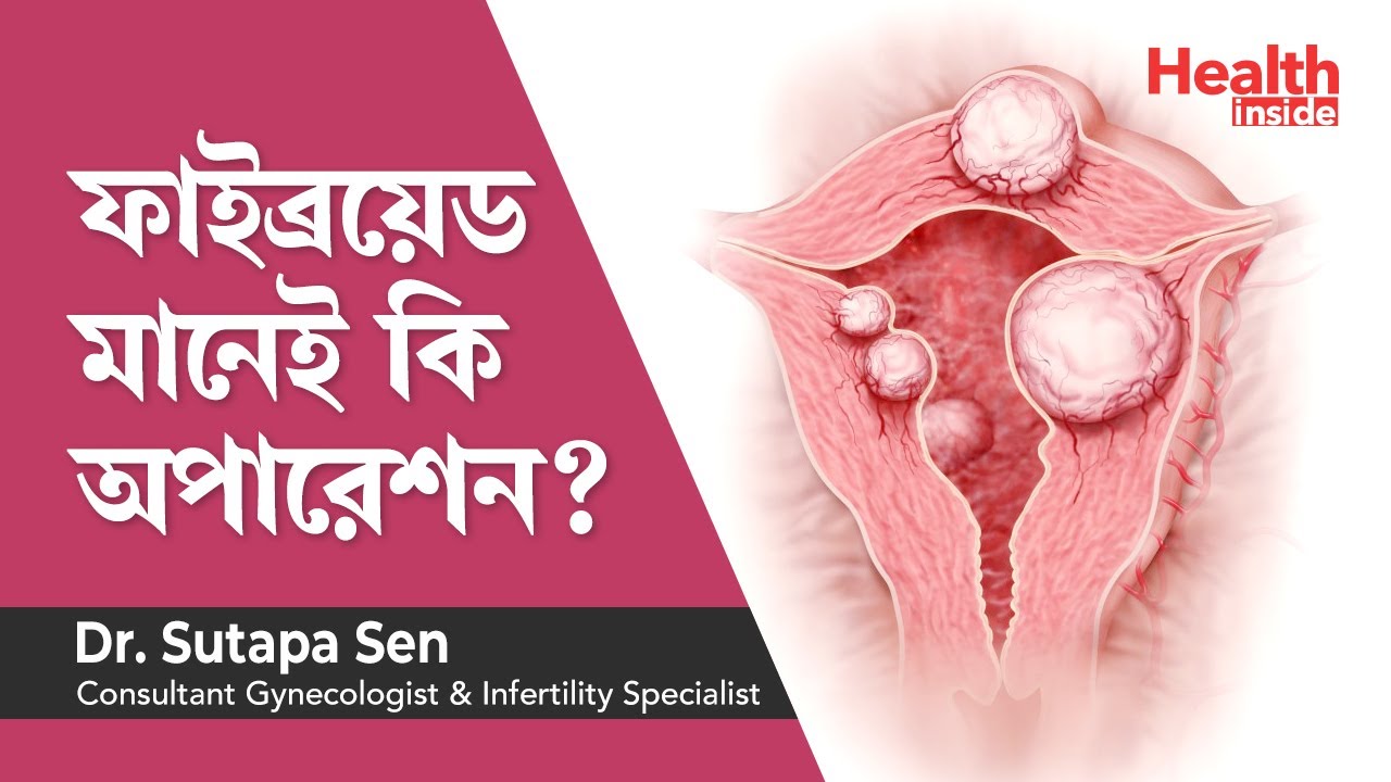 জরায়ুতে ফাইব্রয়েড এর চিকিৎসা মানেই কি অপারেশন | fibroids in uterus treatment in Bengali