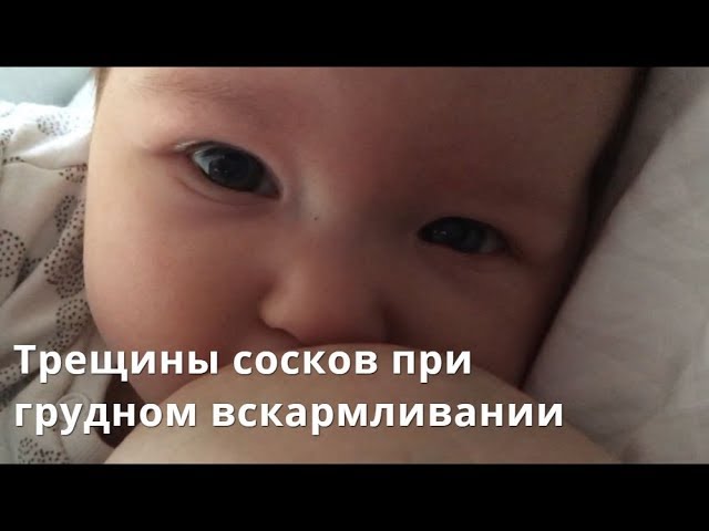 Трещины сосков при грудном вскармливании