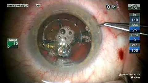 Stephen Slade MD Laser Surgery for Cataracts