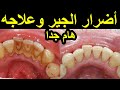 تنظيف جير الاسنان والتهاب اللثة الاسباب والعلاج | اضرار جير الاسنان Teeth Cleaning