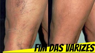 De aranha pernas veias hamamélis para nas