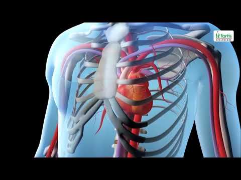 Percutaneous transluminal coronary angioplasty (PTCA) / Percutanius Coronary Intervensi (PCI)