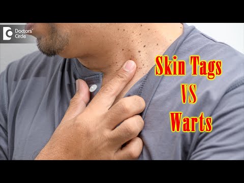 What Causes Skin Tags And Warts? | Get Rid of Warts & Skin Tags- Dr. Renuka Shetty | Doctors&rsquo; Circle