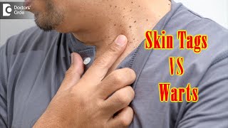 What Causes Skin Tags And Warts? | Get Rid of Warts & Skin Tags- Dr. Renuka Shetty | Doctors' Circle screenshot 1