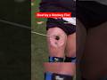 Beating the Nerve in my Leg with a Monkey Fist… #funny #shorts #comedy