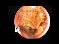 Re examination of cholesteatoma ,14mins,20221219