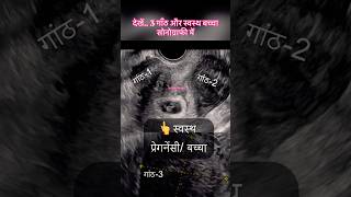 बांझपनमें बच्चा रहने का सफल इलाज-बिना आइ वी एफ / आइ यु आइ के केवल 2 महीने की दवाई से #fibroid #reel