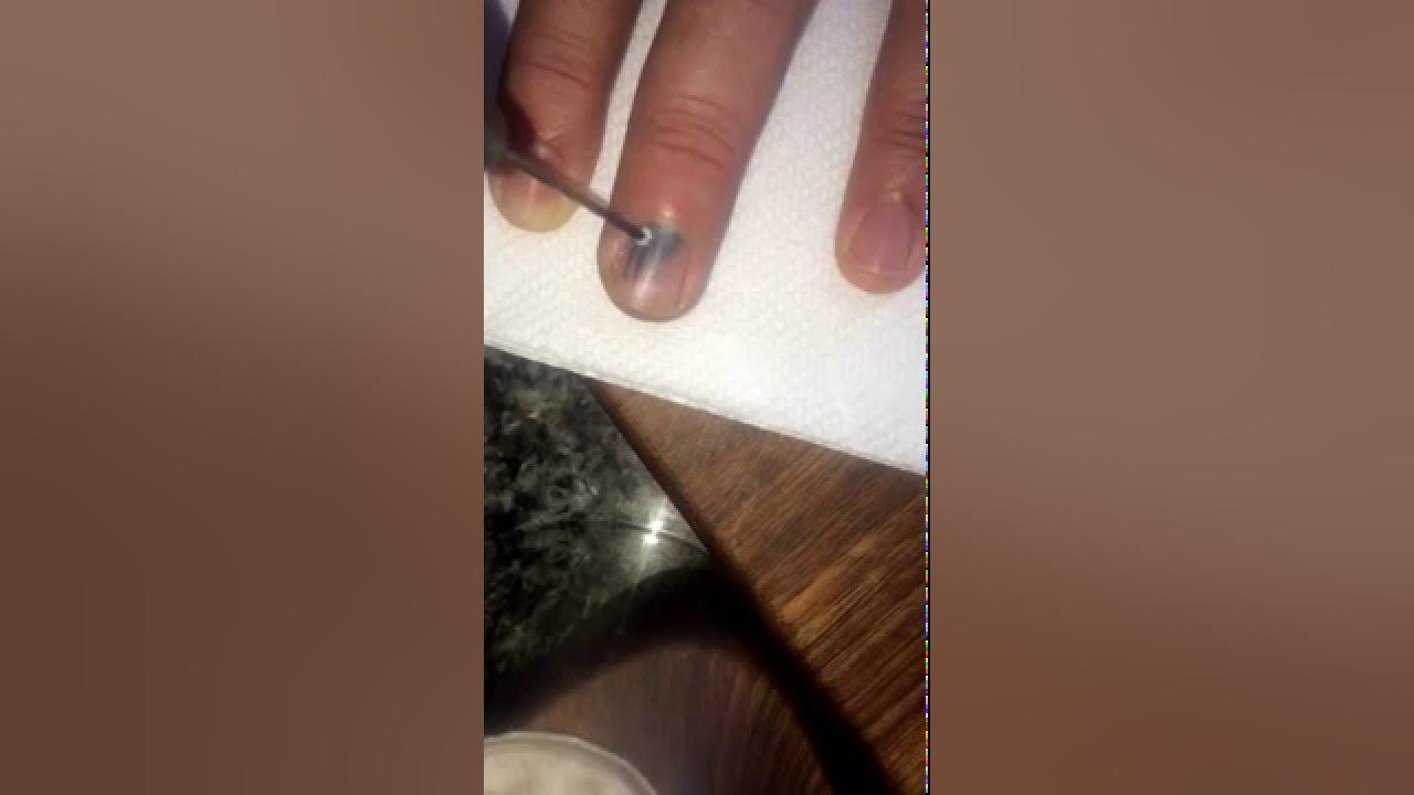 Crushed fingernail repair YouTube