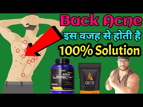 How to Get rid of back acene ll Acne problem ll Reason or solution ll SP FITNESS ll