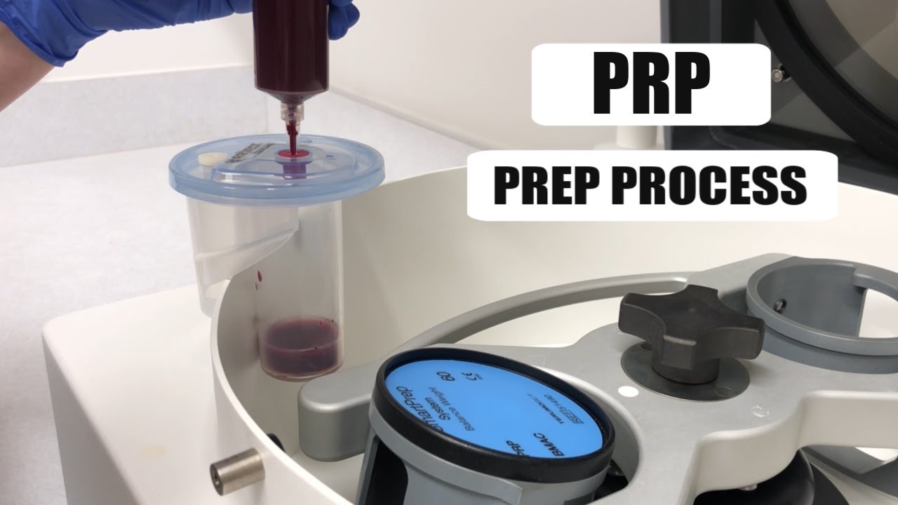 PRP INJECTION PROCESS | KALOS FACIAL PLASTIC SURGERY