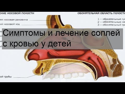 Симптомы и лечение соплей с кровью у детей