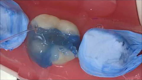 O que é inlays e onlays?