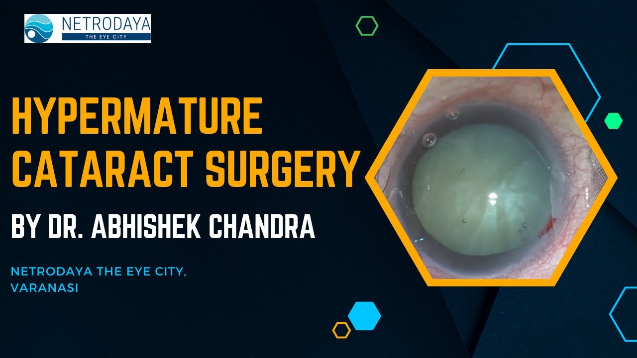 Hypermature Cataract Surgery Phacoemulsification and IOL Implantation by Dr. Abhishek Chandra