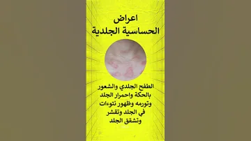 اعراض الحساسية الجلدية حكة في الجلد الهراش وأبرز أعراضها العامة والأكثر شيوع ا 
