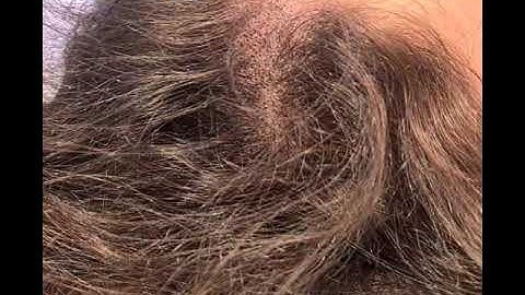 Density Restoration SMP Scalp Micropigmentation by El Truchan @ Scalp Micro Definition by El Truchan