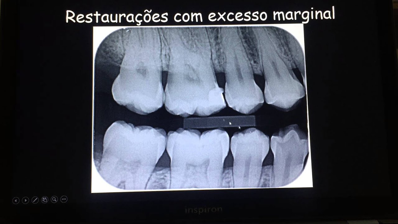 ALTERAÇÕES RADIOGRÁFICAS DAS LESÕES PERIODONTAIS