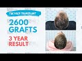 ASMED - Dr. Koray Erdogan - 2600 Grafts (Manual FUE) - 3 Year Hair Transplant Result