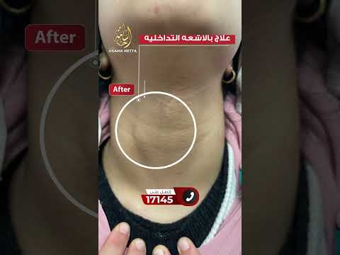 أصعب حاجة في تضخم الغدة الدرقية إن الأعراض بتتعبك نفسي ا قبل ما تتعبك جسدي ا