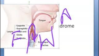 Obstetrics Mendelson syndrome aspiraton general anesthesia complication pregnancy cesarean operative