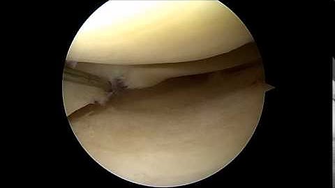 Partial Meniscectomy Overview from a Scottsdale Orthopedic Surgeon