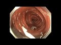 Colonoscopy: Colon Polyp with Cancer - which one needs surgery after EMR