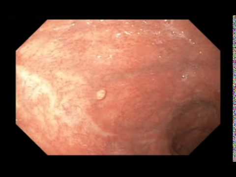 Video: Polip Pancreatic