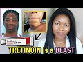 😱Tretinoin Is Not Working For You ✅ Here is How You fixed It And Get Results😎...