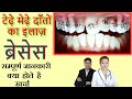 Braces  complete information for india          
