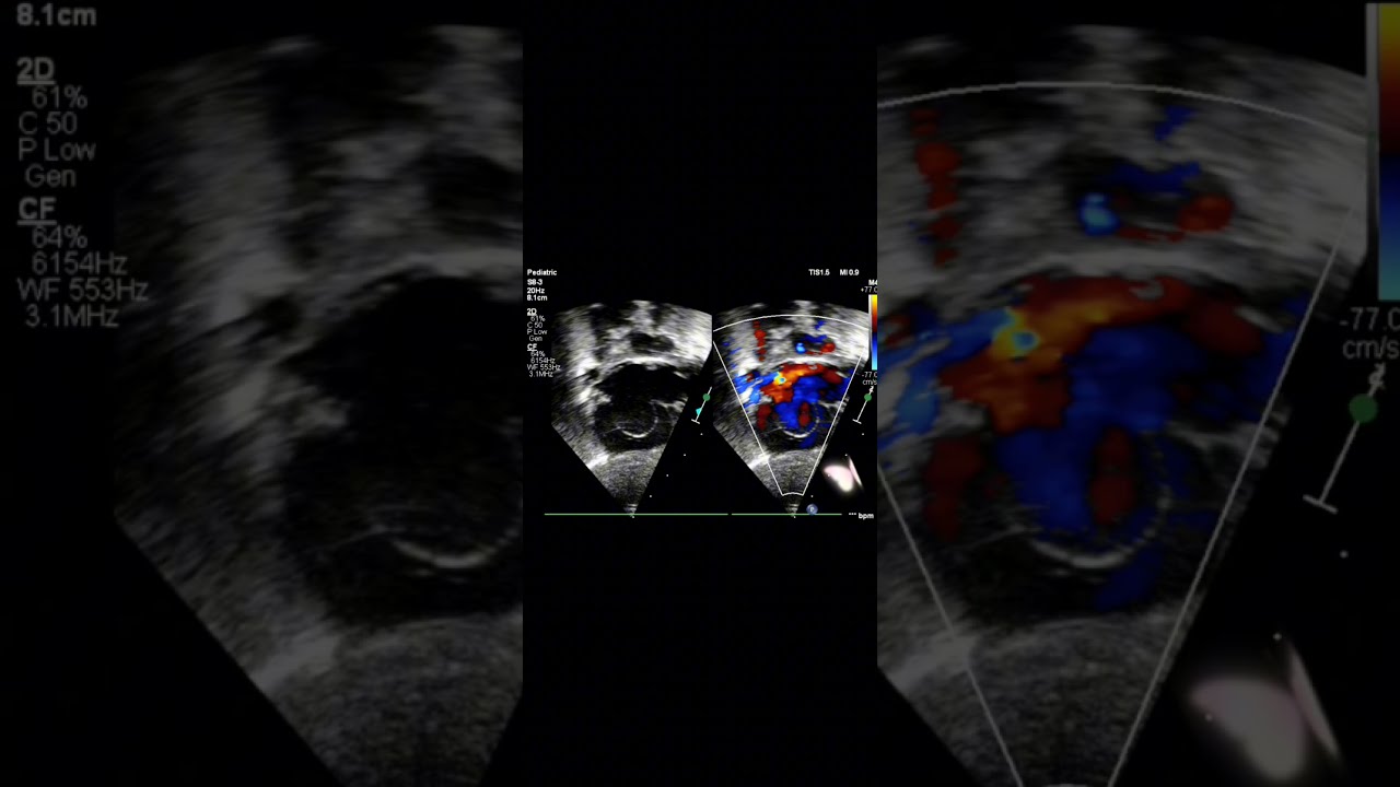 congenital heart ❣️ defects 