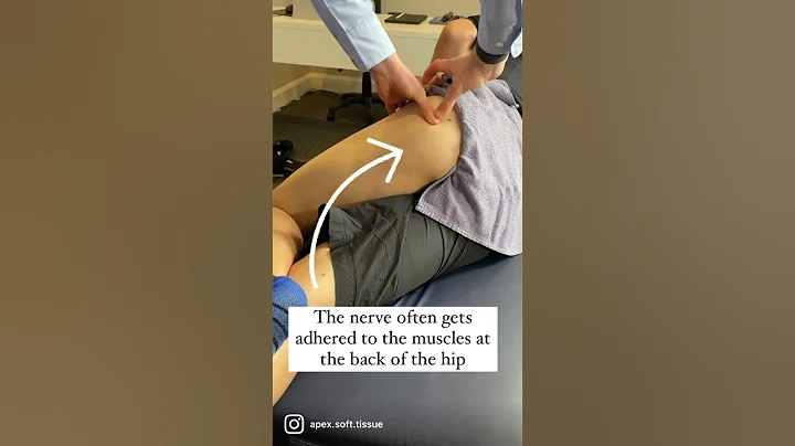 Sciatic Nerve Entrapment at the deep gluteal space (posterior hip) - DayDayNews