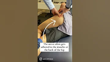 Sciatic Nerve Entrapment at the deep gluteal space (posterior hip)