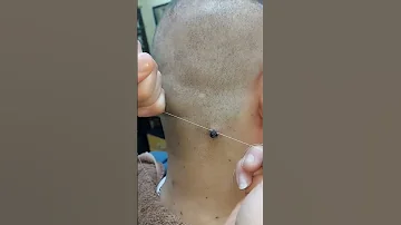 إزالة زوائد جلديه على فور 