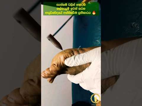 Ayurvedic treatment for stone bruises without surgery