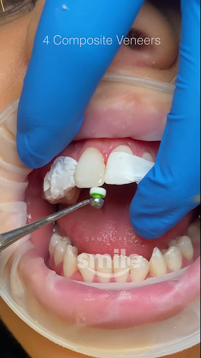 4 Composite Veneers #shorts