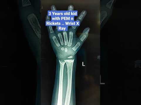Rickets Xray