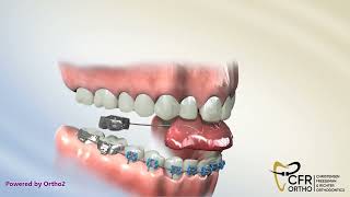 Fixed Bite Plate for Breakage