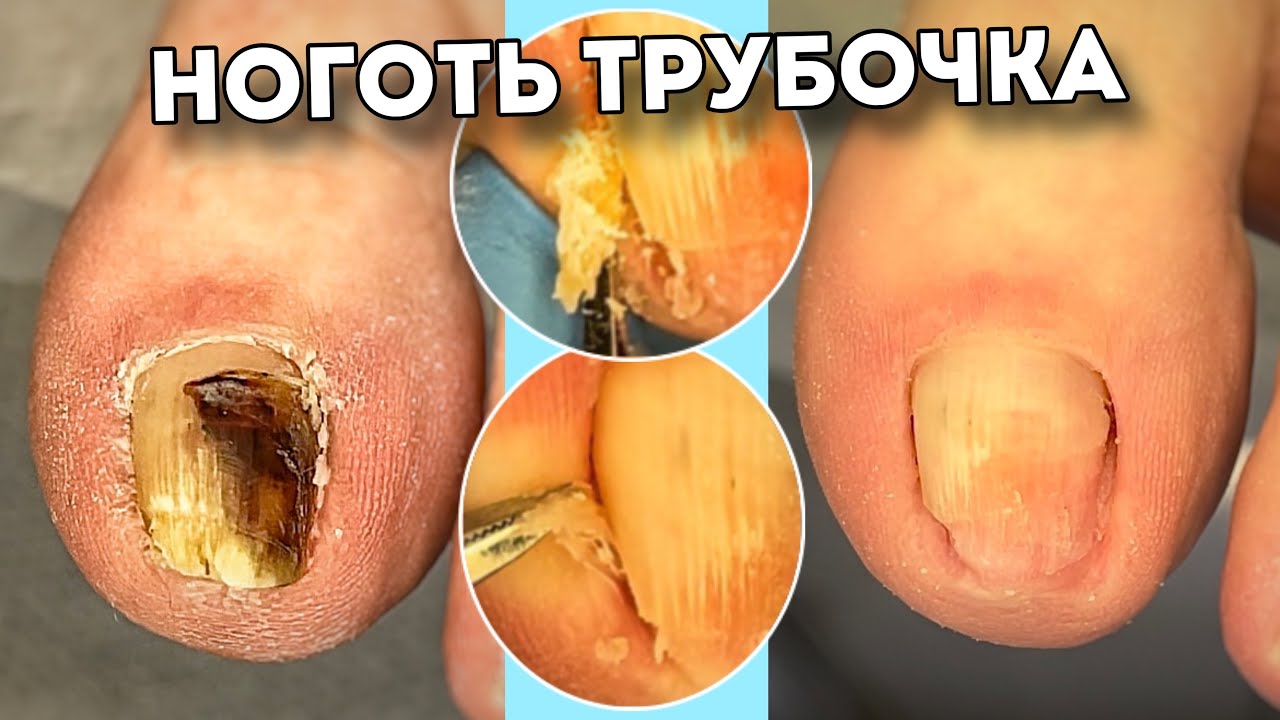 Трубчатый ноготь с обширной гематомой #подологтатьянапак - YouTube