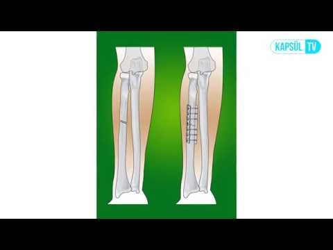 Platin Hangi Durumda Ve Neden Takılır?