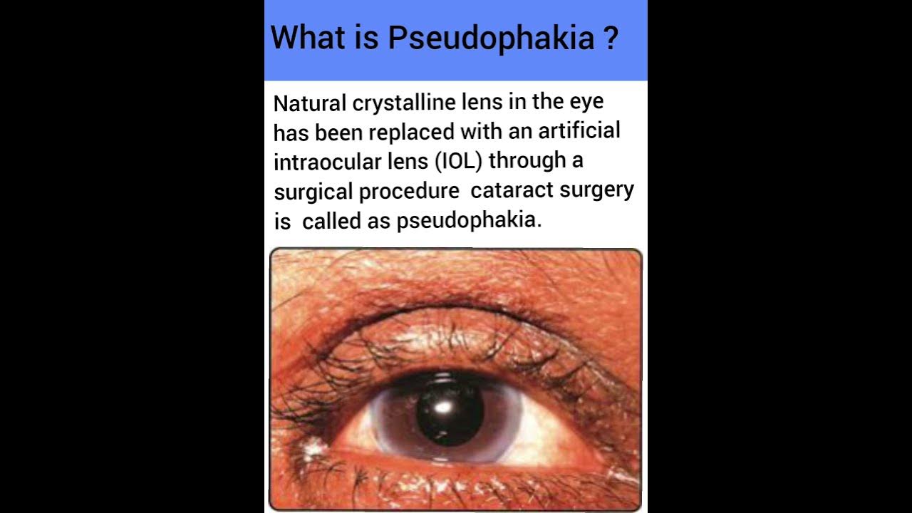 Semi Supervised Object Detection Pseudophakia Of Both Eyes