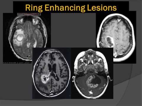 This Podcast Will Kill You - Can you spot the ring enhancing lesions in  this MRI? They're caused by Toxoplasma gondii, which can cause cerebral  toxoplasmosis in people who are immunocompromised. From