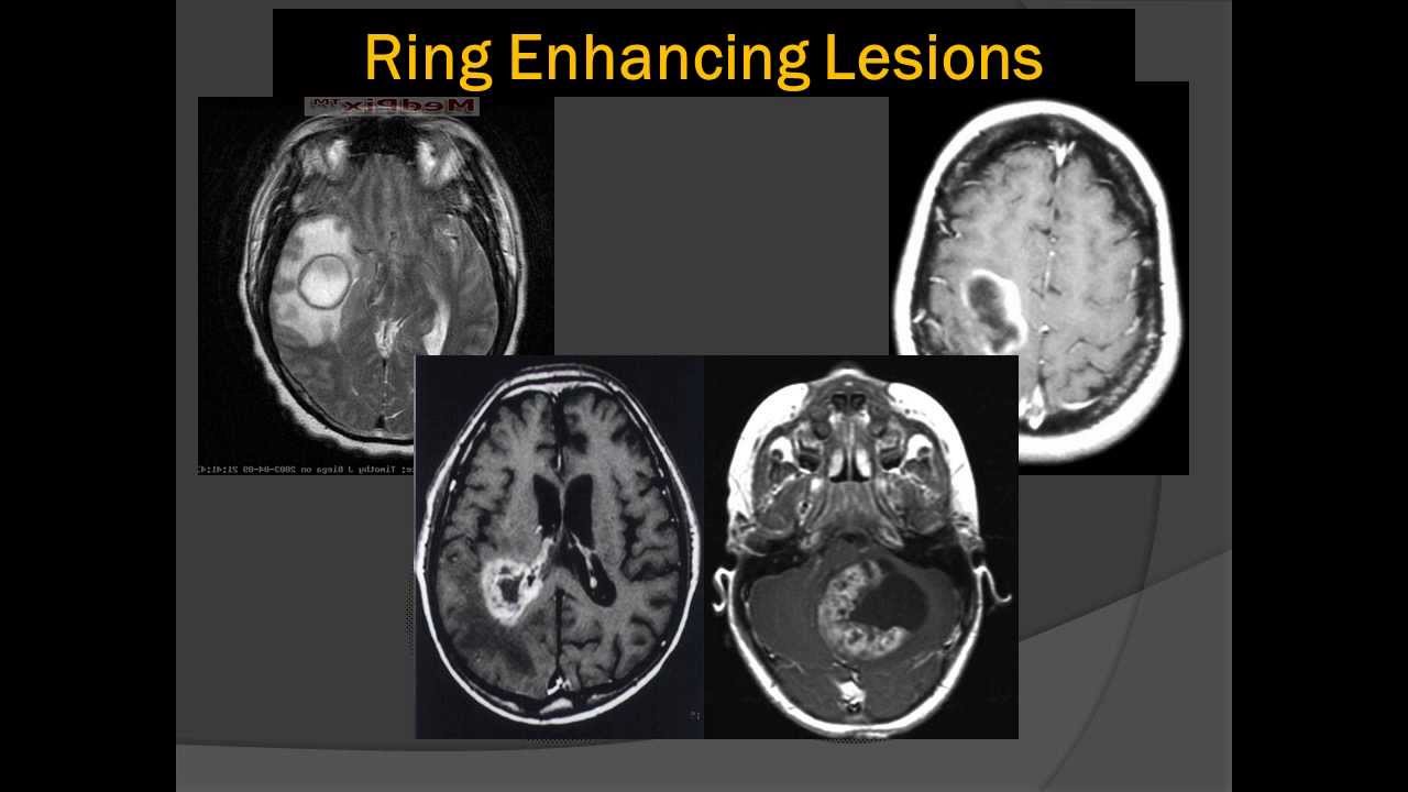 A) Contrast MRI brain showing conglomerated ring enhancing lesions in... |  Download Scientific Diagram